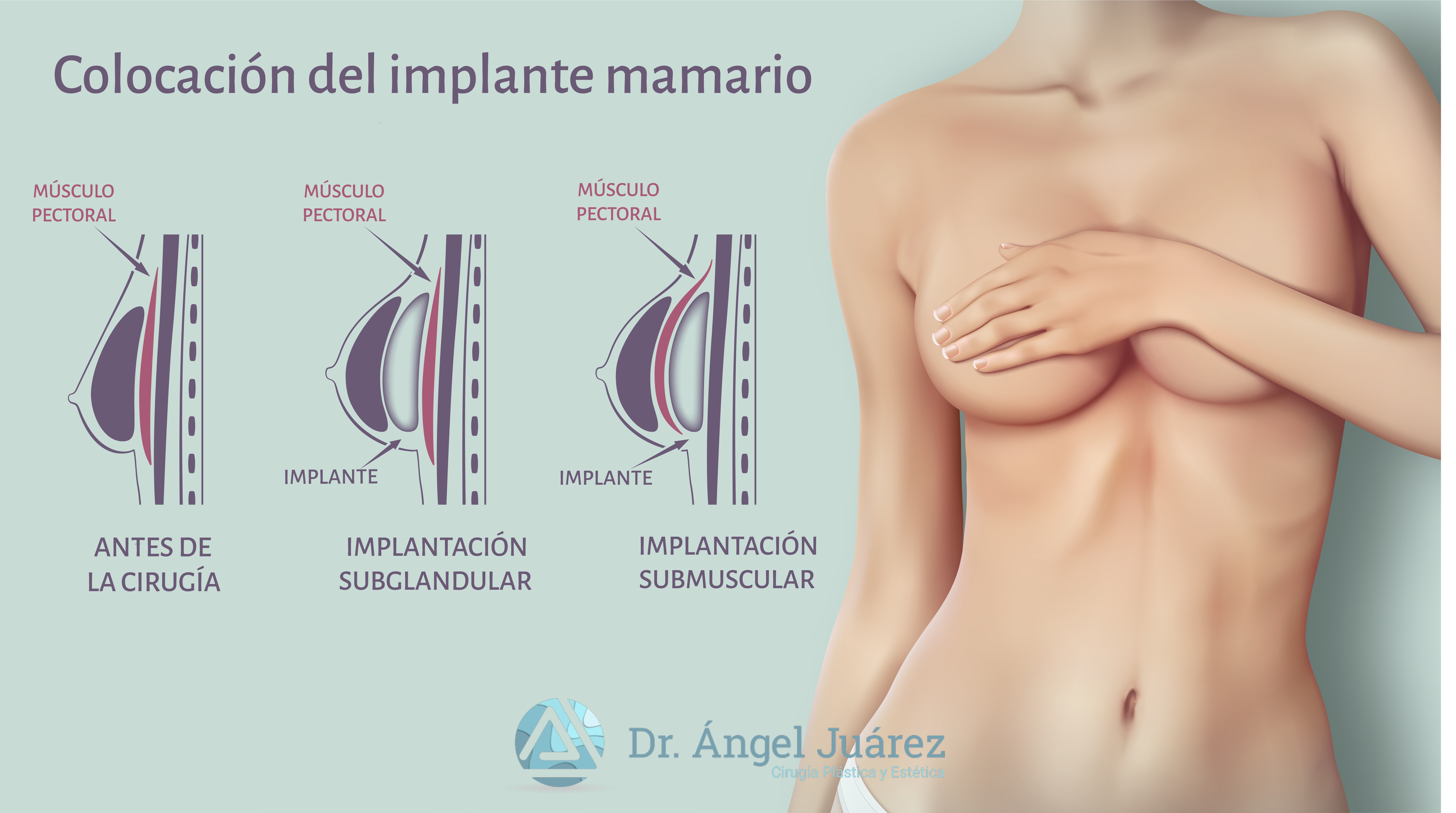 Colocación del implante mamario - Dr. Ángel Juárez